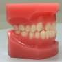 Underbite is associated with tooth loss risk