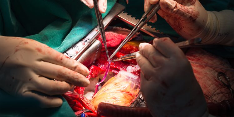 One Troponin Assay Would Suggest Whopping MI Incidence After Cardiac Surgery