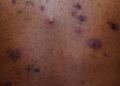 Make the Diagnosis: Is This Eruption Related to the Patient’s Acne? His Ulcerative Colitis?