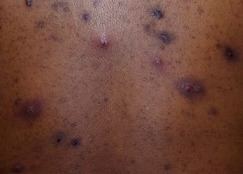 Make the Diagnosis: Is This Eruption Related to the Patient’s Acne? His Ulcerative Colitis?