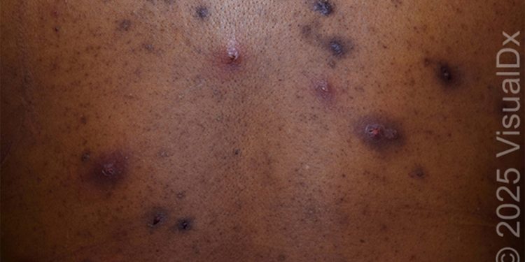 Make the Diagnosis: Is This Eruption Related to the Patient’s Acne? His Ulcerative Colitis?