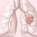Early Lung Cancer Data Show Why FDA Approved HER2 Agent in First-Line