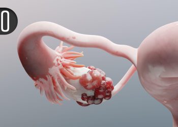 Novel Regimen Boosts Survival for Recurrent Platinum-Resistant Ovarian Cancer