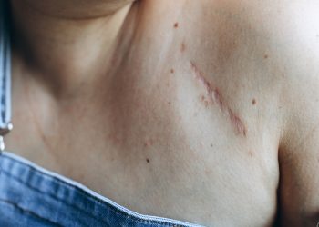 Why scars never disappear