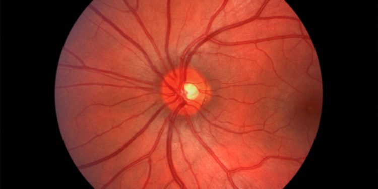 Citations of Retracted Ophthalmology Papers Persist, Study Warns