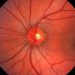 Citations of Retracted Ophthalmology Papers Persist, Study Warns