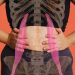 Can You Fix Diastasis Recti a Decade After Giving Birth?