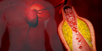 New treatment cuts bad cholesterol by nearly 50% without statins
