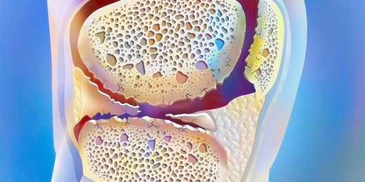 This Growth Factor May Play a Bigger Role in Osteoarthritis Than Previously Thought