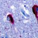Midlife Vitamin D Levels Tied to Lower Tau Burden