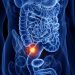 Are We Missing Tumors When Using Antibiotics Alone for Appendicitis?
