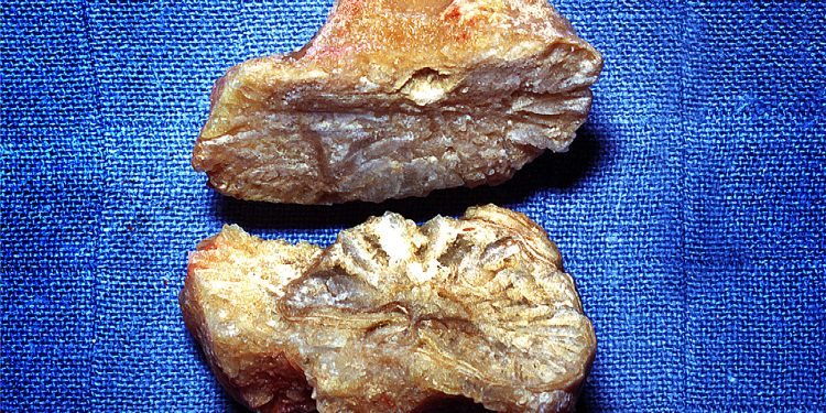Trial Questions Fluid Intake Targets for Preventing Urinary Stone Recurrence