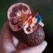 I’m a kidney surgeon: Here’s why I hope I never see you