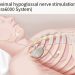 Next-Gen Nerve Stimulator Approved for Obstructive Sleep Apnea
