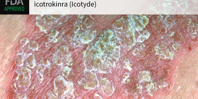 ‘Potential Game Changer’ for Psoriasis Gets Green Light From FDA