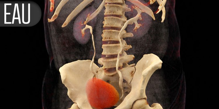 PSMA-PET Cuts Need for Biopsy in Suspected Prostate Cancer