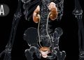 No Prostate Cancer Survival Benefit With More Extensive Lymph Node Assessment