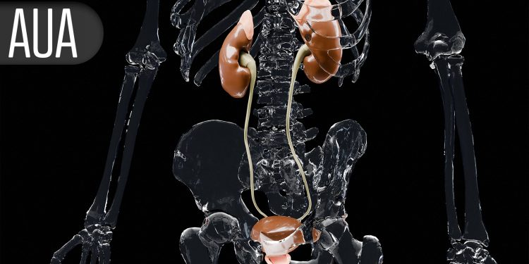 No Prostate Cancer Survival Benefit With More Extensive Lymph Node Assessment