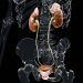 No Prostate Cancer Survival Benefit With More Extensive Lymph Node Assessment