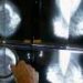 When should you get a mammogram? Conflicting advice makes it hard to know