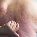 GLP-1 Drug Makes Its Case for Treating Plaque Psoriasis