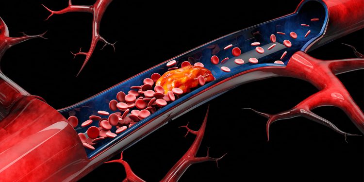 Endovascular Thrombectomy Boosts Outcomes in Medium-Vessel Ischemic Stroke