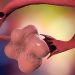 New Name for PCOS More Accurately Reflects Condition
