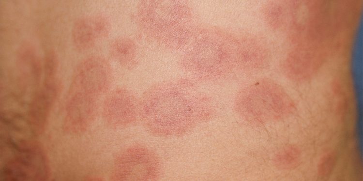 Drug Targeting TLRs in Cutaneous Lupus Looks Good in Mid-Stage Studies