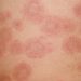 Drug Targeting TLRs in Cutaneous Lupus Looks Good in Mid-Stage Studies