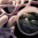 Protein Supplement Tied to Better Outcomes for Patients on Dialysis