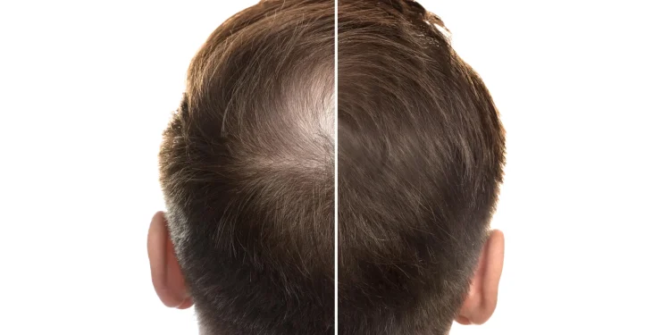 Ancient Chinese medicine could transform hair loss treatment