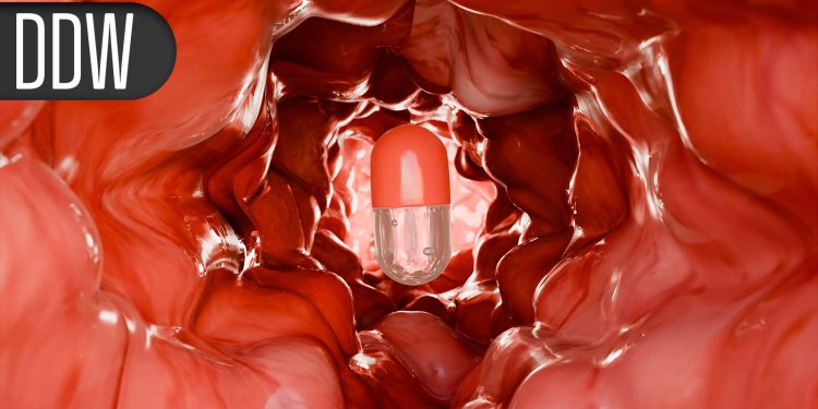 5-Year Data Support Top-Down Therapy in Crohn’s Disease