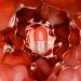 5-Year Data Support Top-Down Therapy in Crohn’s Disease