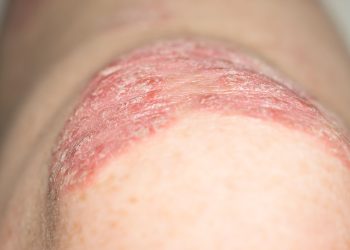NPF Primer: GLP-1s Worth Considering as Adjunct for Select Psoriasis Patients