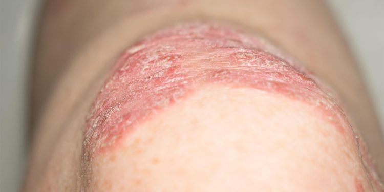 NPF Primer: GLP-1s Worth Considering as Adjunct for Select Psoriasis Patients
