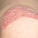 NPF Primer: GLP-1s Worth Considering as Adjunct for Select Psoriasis Patients