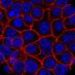 Blocking a cellular inflammation process could result in effective therapy for pancreatic cancer