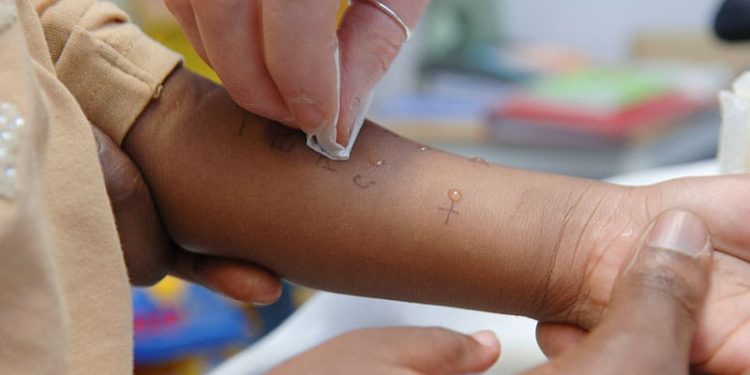 Are Food Allergies Overdiagnosed in Black Patients?