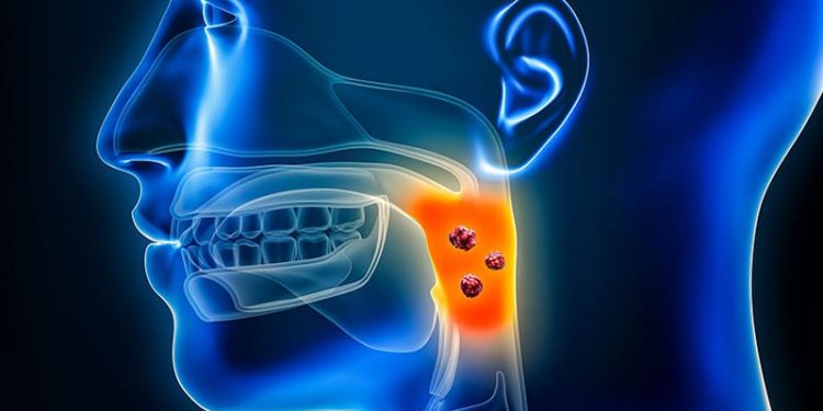 Can Deintensified RT Work in HPV+ Oropharyngeal Cancer?