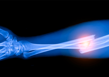 If You’re Counting on Calcium and Vitamin D Supplements to Prevent Fractures, Think Again