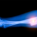 If You’re Counting on Calcium and Vitamin D Supplements to Prevent Fractures, Think Again