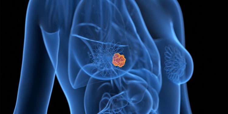 FDA Panel Gives Thumbs Down to Novel Strategy for Switching Breast Cancer Therapy