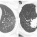 Lung scans can reveal important differences in sarcoidosis severity according to new study