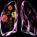 High Rate of Surgical Success in Complex NSCLC With Neoadjuvant Chemoimmunotherapy