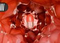Can Endoscopic Procedure Slow Post-1 Weight Rebound?