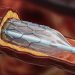 GLP-1 Drugs Make Promising Debut in TAVR, Carotid Artery Stenting