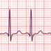 Think Heart Attacks Cause Most Sudden Cardiac Deaths? Think Again, Study Says