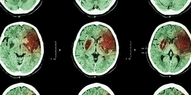 FXIa Inhibitor Hits Mark in Recurrent Stroke Prevention