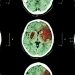 FXIa Inhibitor Hits Mark in Recurrent Stroke Prevention