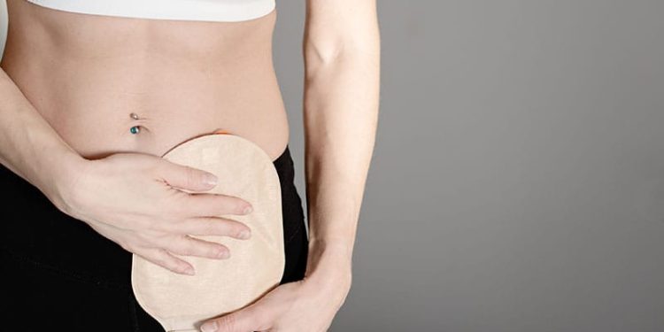 Colorectal Cancer Predicted to Keep Rising in Younger Adults